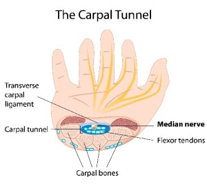 Carpal tunnel syndrome steroid injection procedure